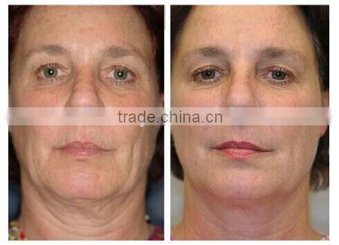 Lowest Price roller skate led light Microneedle Derma Roller