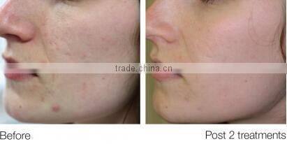 AYJ-X10 microdermabrasion machine wet scrubber machine