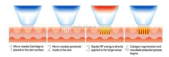 Best RF Skin Tightening Face Lifting Machine MultiShape Mini