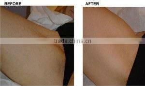 professional laser hair removal machine