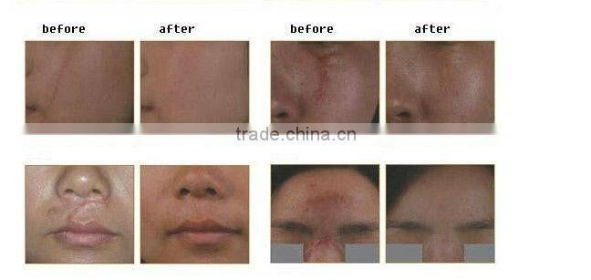 medical super pulse Laser co2 fractional equipment for skin beauty scar removal skin rejuvenation clinic use