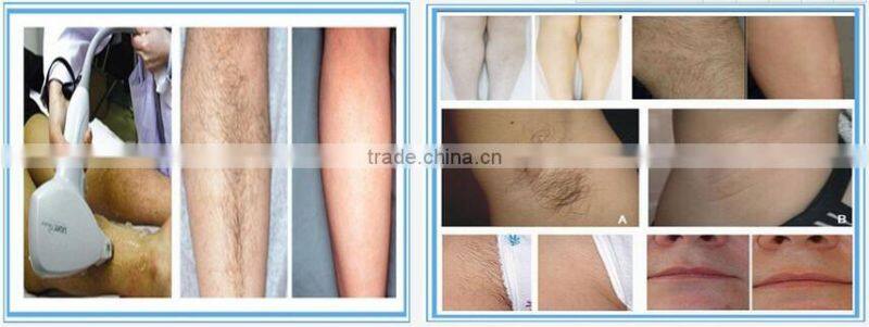 distributor wanted europe 808nm diode laser hair removal speed 808