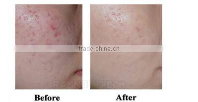 40W RF Tube with Vaginal Rejuvenation Fractional CO2 Laser Equipment