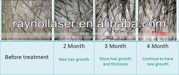 Top Sale 650nm Diode Laser Best Hair Regrowth Machine