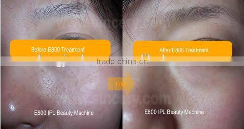 Vertical E-light IPL machine, skin photo aging treatments and hair removal german skin solution e-light