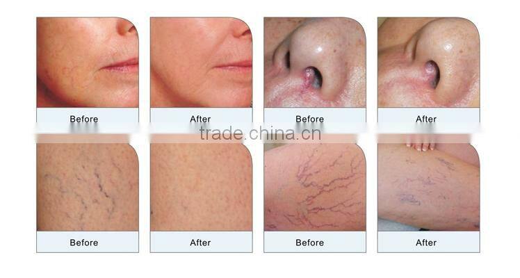 distributor low price ! 980nm spider vein removal machine vascular remover 980 varicose vein laser