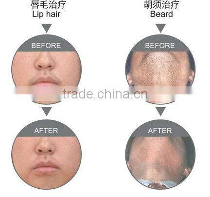 Portable professional IPL hair removal machine distributors wanted