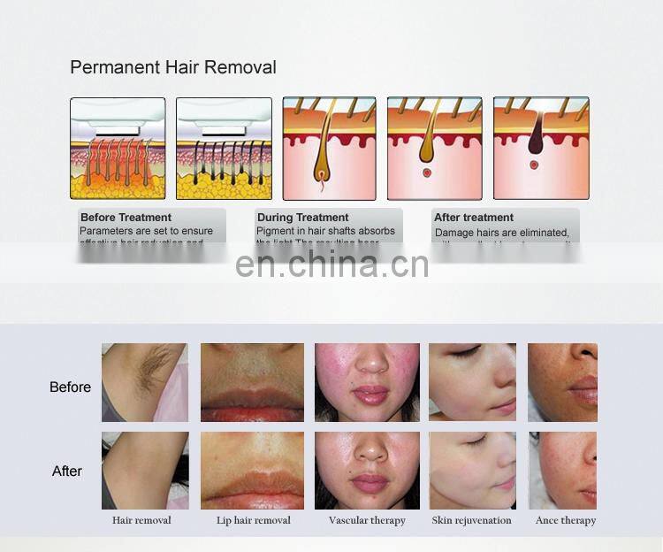 2019 Latest OPT Epilation Machine /Beauty Equipment Shr Hair Removal And Tattoo Removal Machine