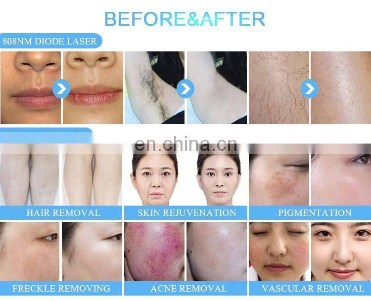 Multifunction Elight acne removal wrinkle reduce skin rejuvenation & 808 diodel laser hair removal