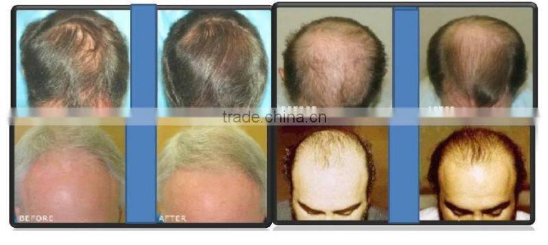 PDT Led Laser Diode Hair Regrowth Machine For Hair Lossing