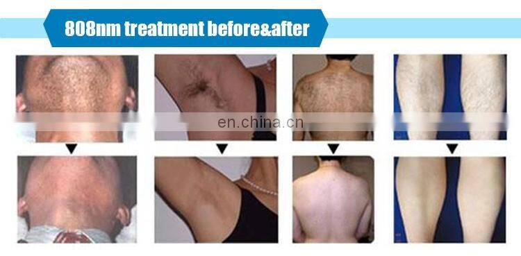 Beauty 808 Diode Laser Hair Removal Machine 2000w Infrared Laser Diode with CE