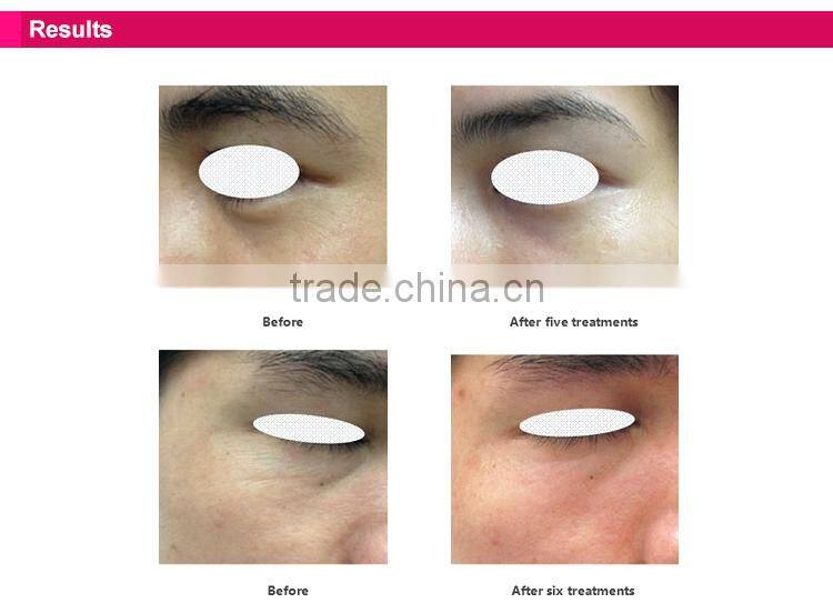 Home use under eye treatment