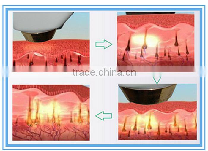 Painless 808nm diode laser hair removal machine