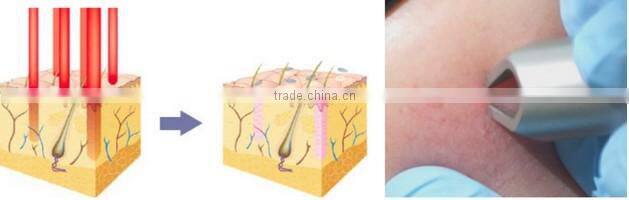 RBS03- Ramya 980nm laser RBS non-invasive spider veins treatment