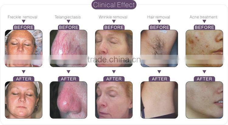 2016 OEM e-light ipl rf nd yag laser multifunction machine with rf 2014 unwanted hair