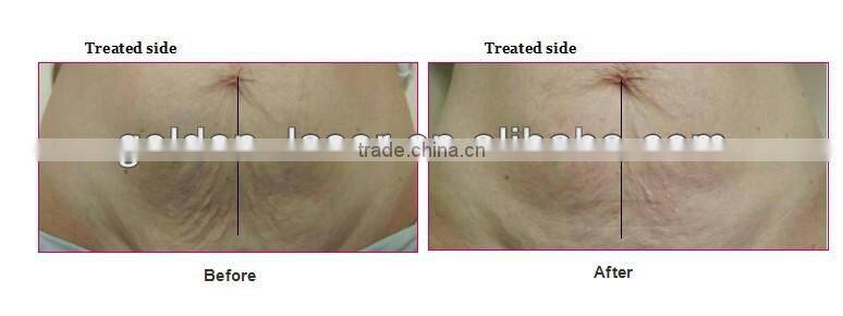 cheapest Israel viora reaction reaction beauty machine