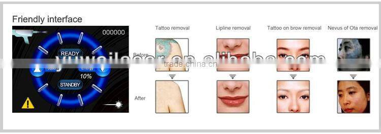Q-switched ndyag laser,professional for tattoo,pigment ,eyebrow removal