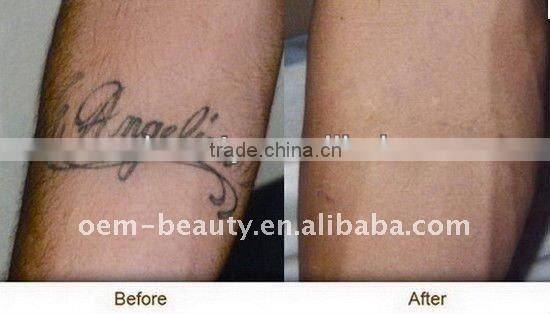 Professional Q switched nd yag laser tattoo removal machine