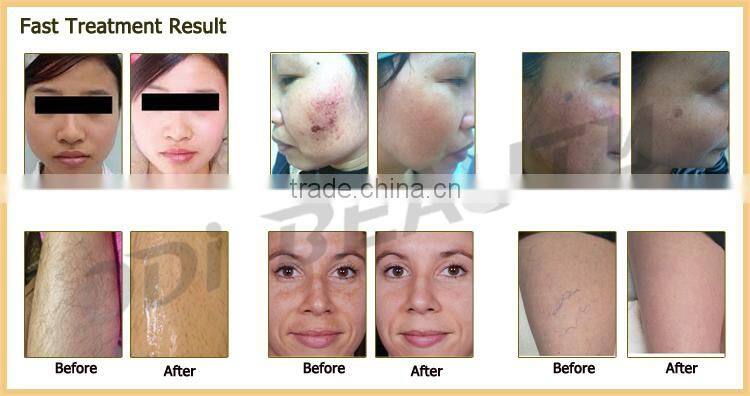 Beauty salon equipment ipl skin rejuvenation elight ipl rf beauty machine