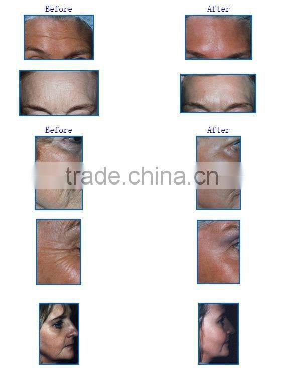 YUWEI Portable Radio Frequency Microcurrent Face Lift Machine for Home Use