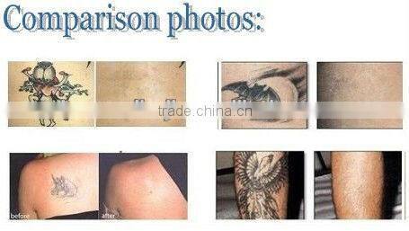 q-switched nd yag laser tattoo removal device