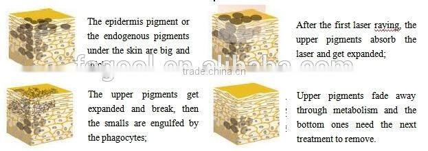 1064nm and 532nm Strong Power Tattoo Pigment Removal Skin Rejuvenation Vertical Q-Switch Laser