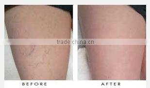 factory price best beauty device / facial veins removal / laser varicose veins treatment