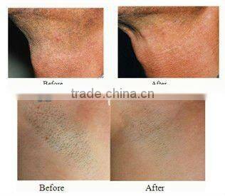 2012 hottest machine,808nm laser hair removal machine