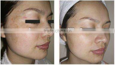 2012 Most Popular Mini beauty Device!! dts 540 titanium micro needle roller L007