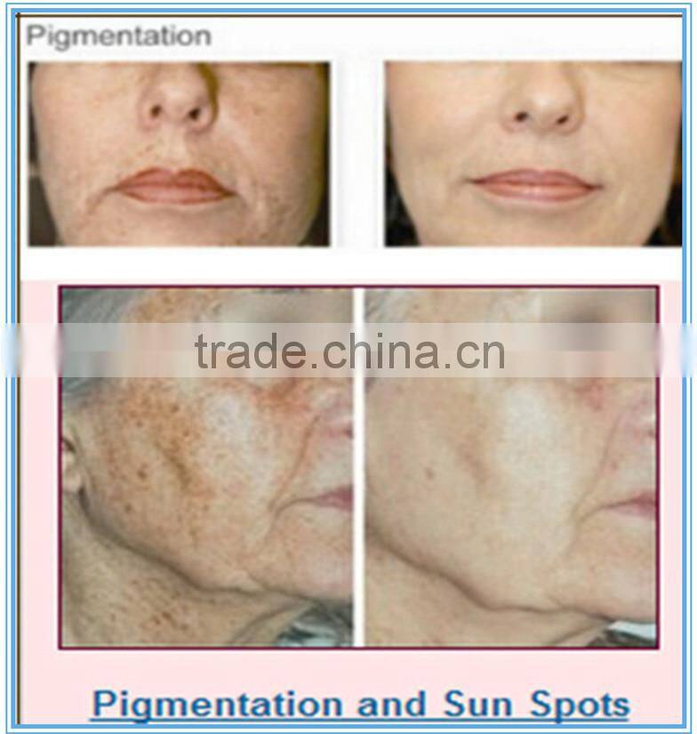 best selling products nd yag laser tattoo removal