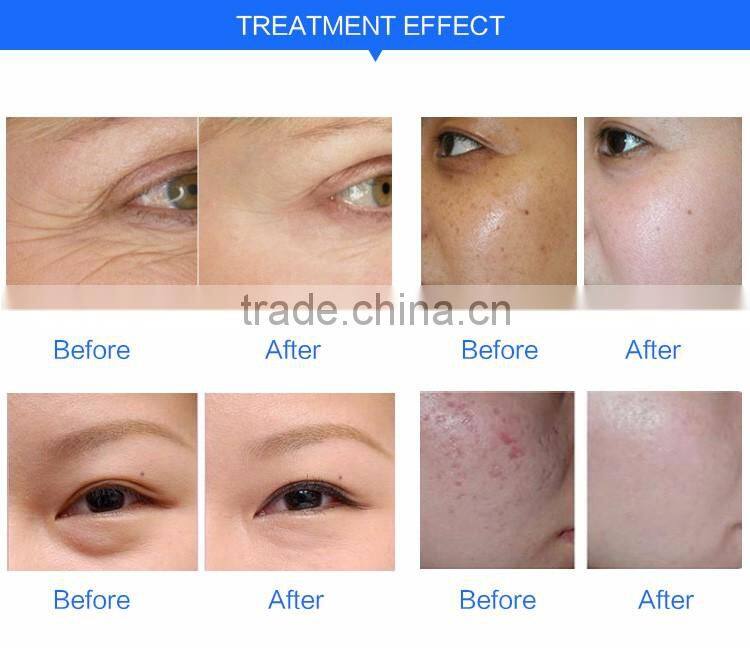 Mini electroporation mesotherapy /needle free mesotherapy facial beauty machine