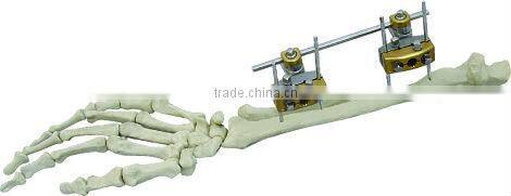 Forearm External Fixator orthopedic external fixation