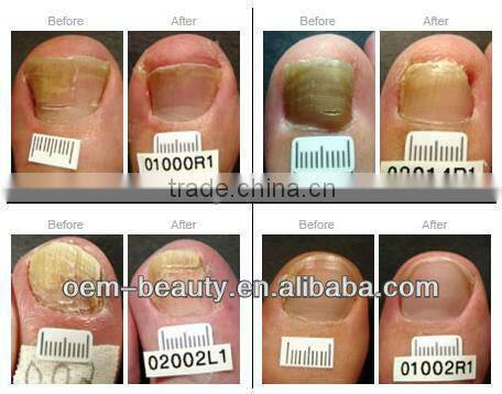 Personal Pain Free Nd Yag laser hair remover and onychomycosis removal