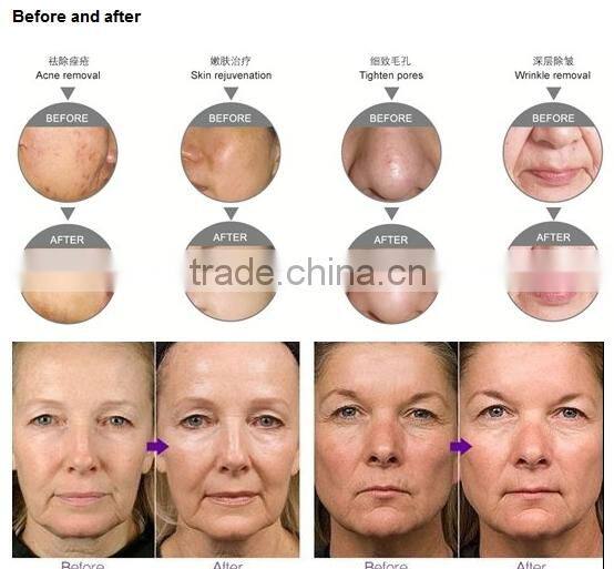 Best selling products in america 2000mj Q switch nd:yag tattoo laser/laser tattoo removal machine price/tattoo removal machine