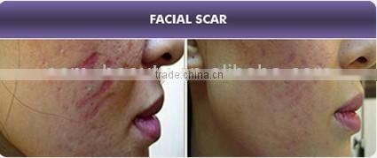 12 needles Mini automatic Microneedle Skin Needling