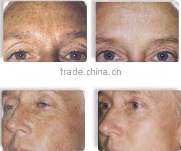 20% discount portable ipl equipment for hair removal with medical ce