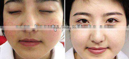 Professional smooth skin machine hair removal ipl beauty machine A003