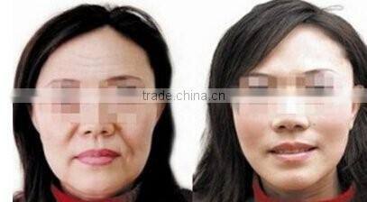 Merry christmas present !portable hifu rf wrinkle removal skin tightening machine for home use