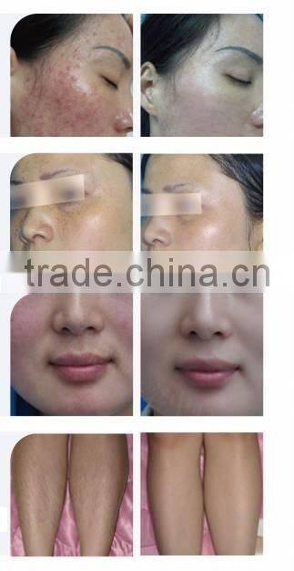 FDA Approved Beauty Equipment SHR Laser IPL Hair Removal /xenon lamp
