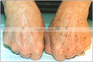 medical aesthetic hair removal ipl laser machine