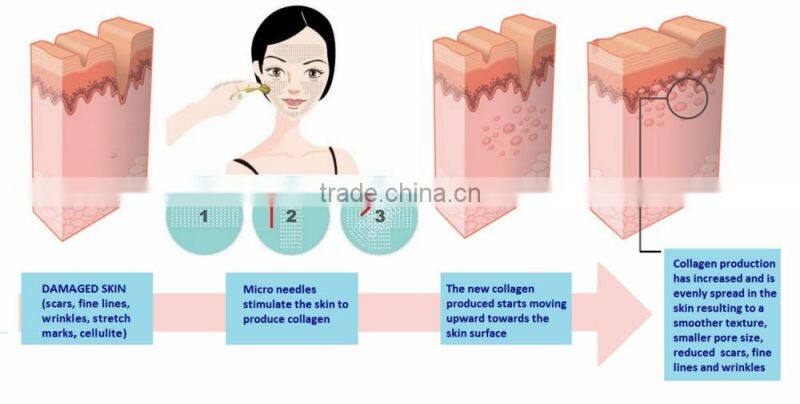Hot sale 1080 needles derma roller serum for microneedle