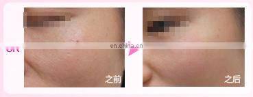 DEESS 3 in 1 with effect replaceable lamps device ipl hair removal beauty product