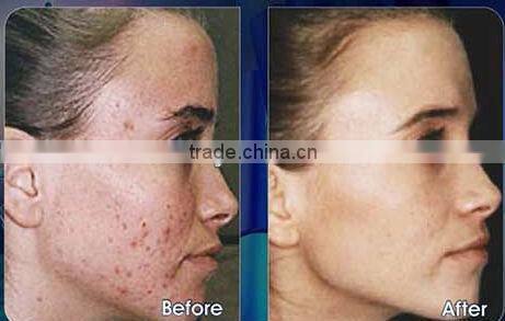 Hottest electric dermaroller,auto disk needle skin roller with private label-EL012A