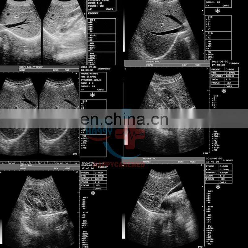 HC-A001 Happycare Full digital Portable 10 inch laptop ultrasound machine scanner Cheapest cheap ultrasound machine device
