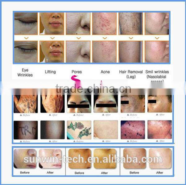 Yes Q-Switch and Nd: Yag Laser Laser Type Q Switched ND:YAG laser Tatto removal