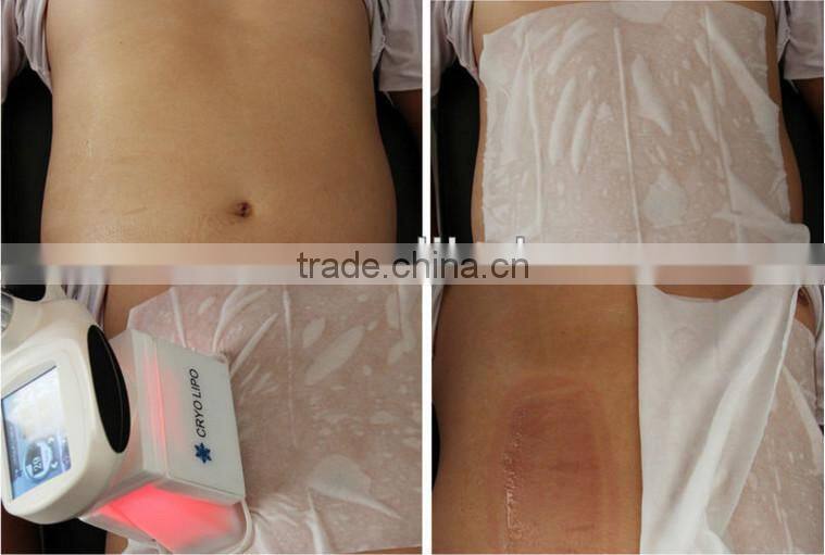 New Portable Vacuum Radio Frequency RF Cryolipolisis Lipolaser Device