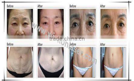 latest 2015 portable rf radio frequency machine/ wrinkle removal and skin lifting machine