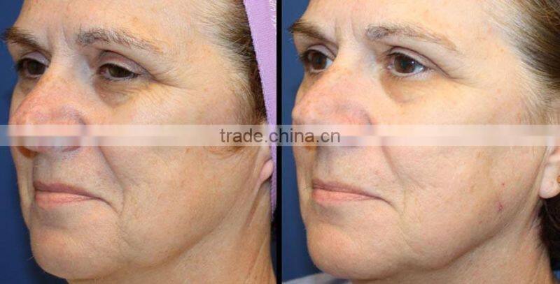 High quality no needle injector Rf heating no needle mesotherapy machine in usa