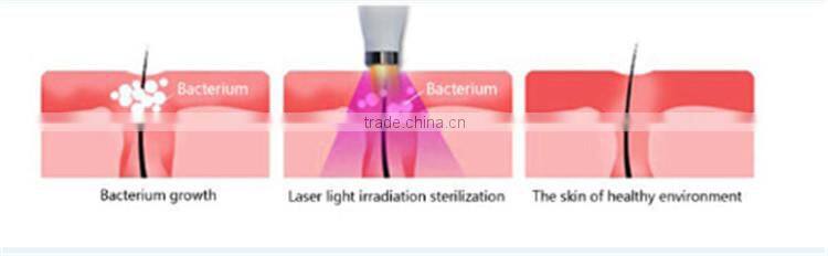 Mini laser acne scar removal device for home used