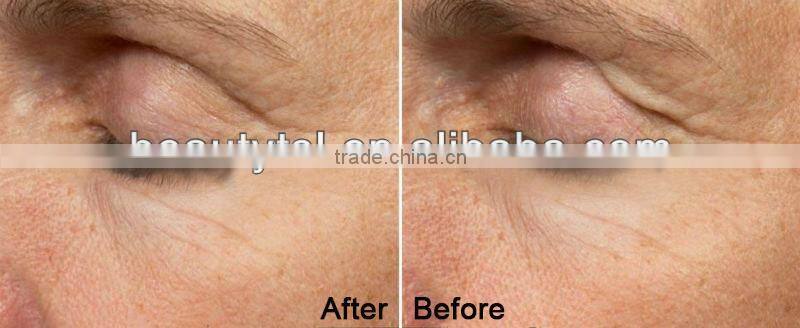 Fractional rf facial microneedle rf fraction machine,Adjustable penetration depth&Adjustable RF treatment output energy